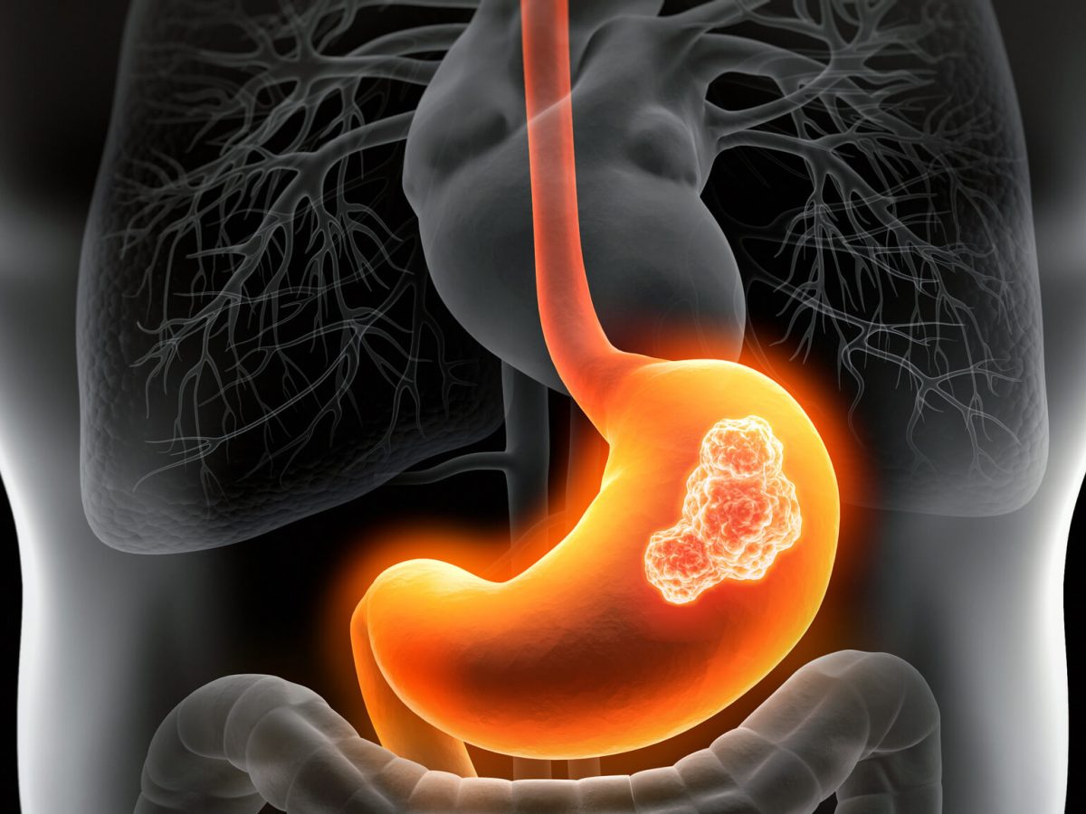 Gastric cancer.