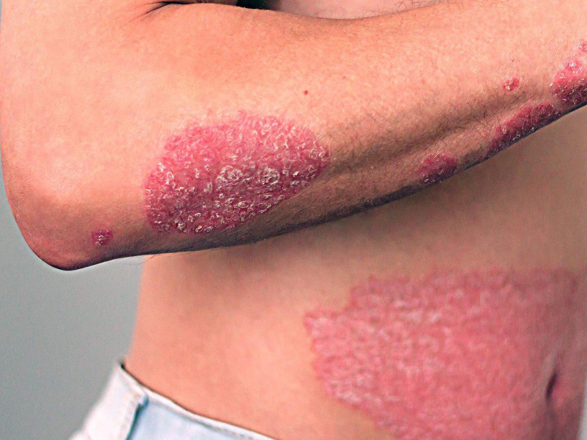Sotyktu: Miracle Pill for Autoimmune Diseases