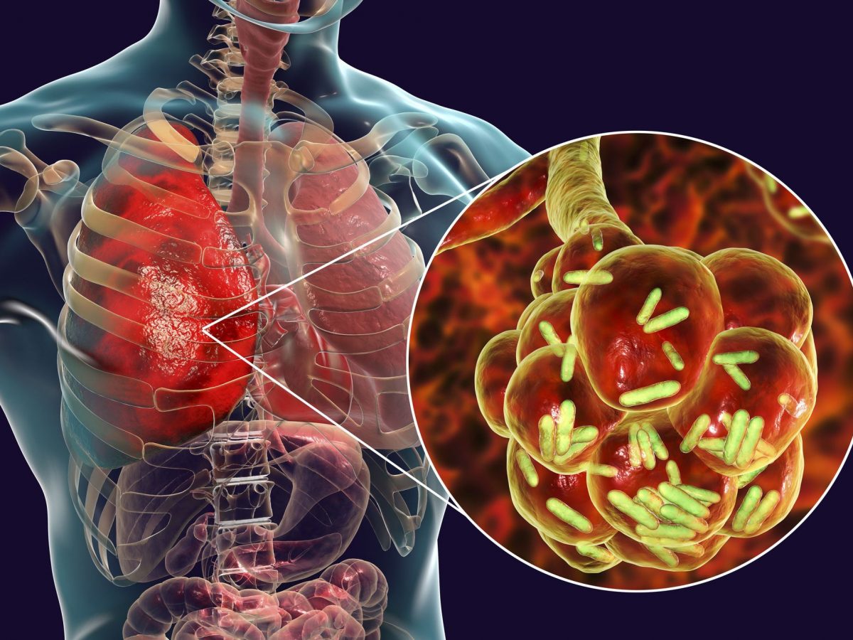 Pneumonia
