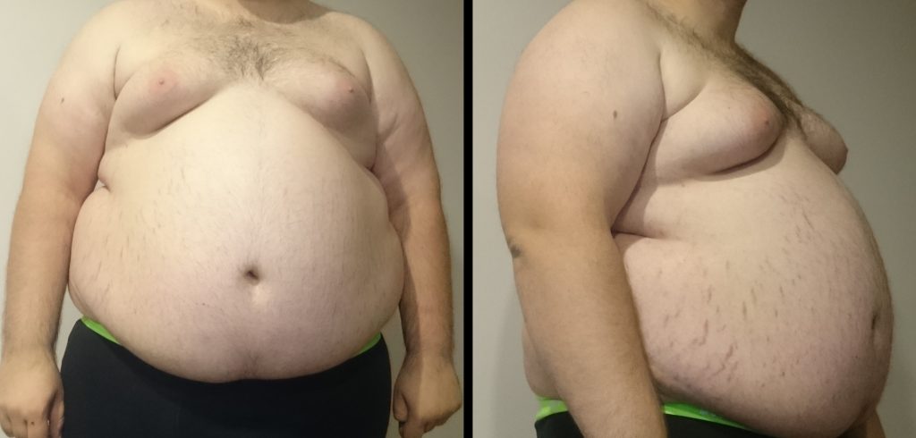 obesity