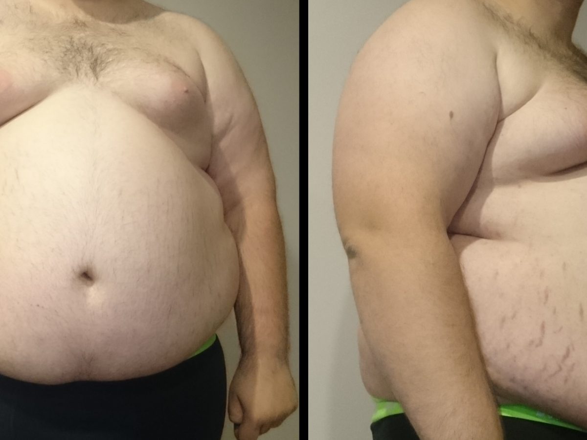 obesity