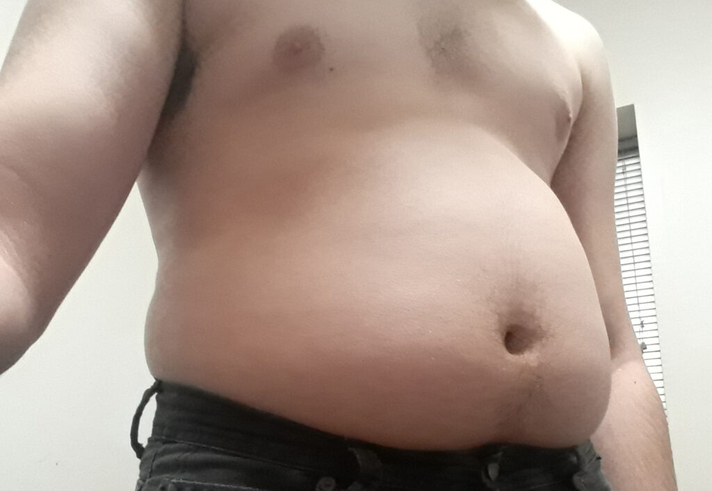 obesity