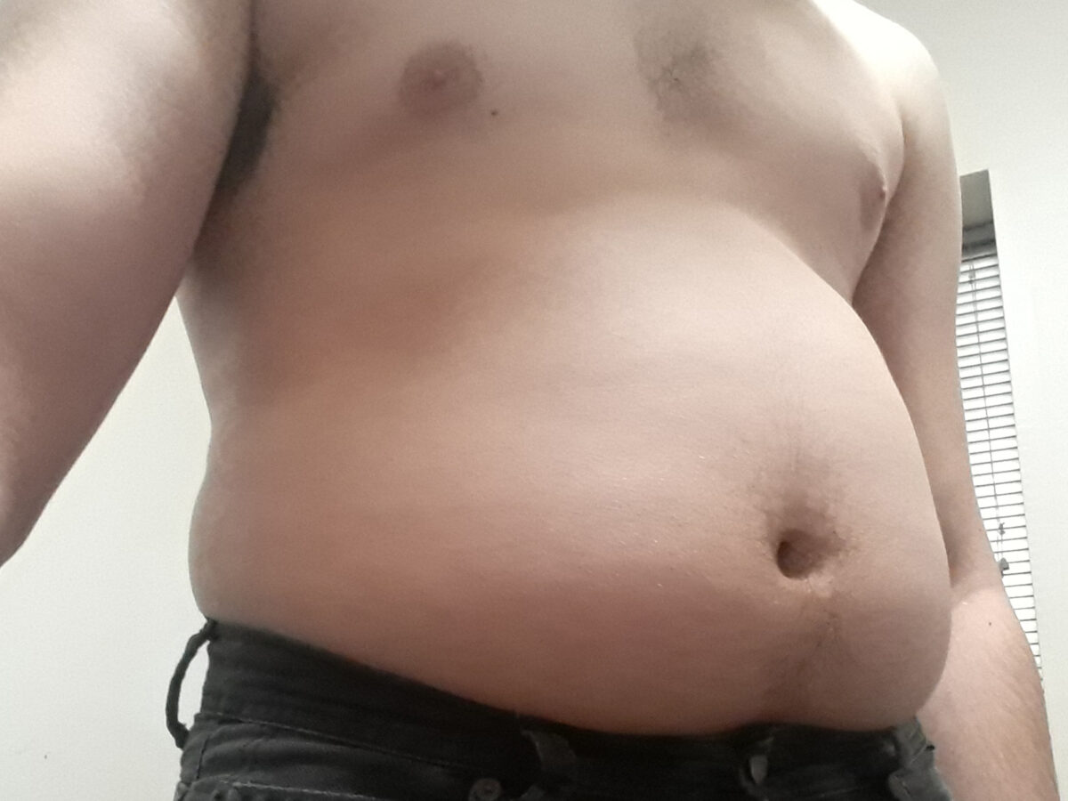 obesity