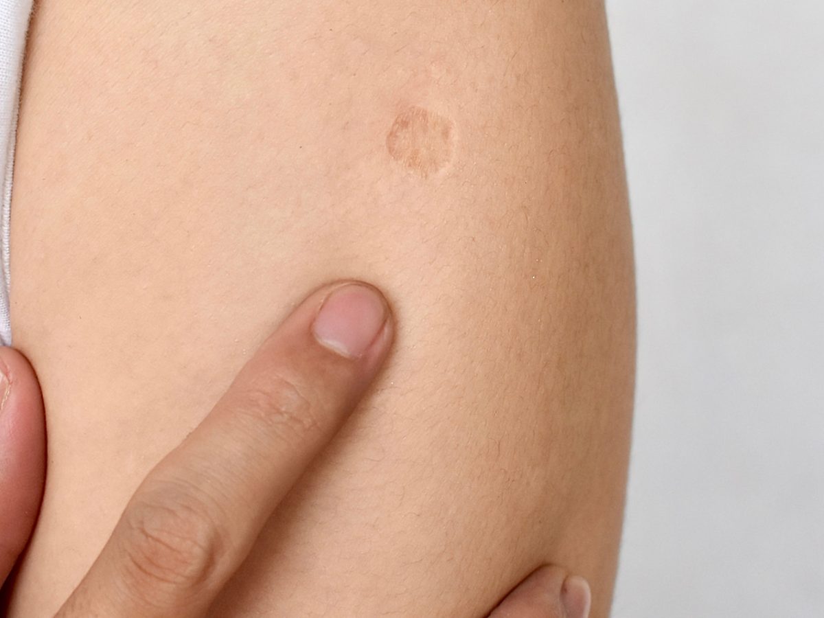 BCG Vaccination: Almost Absolute Protection Against COVID-19