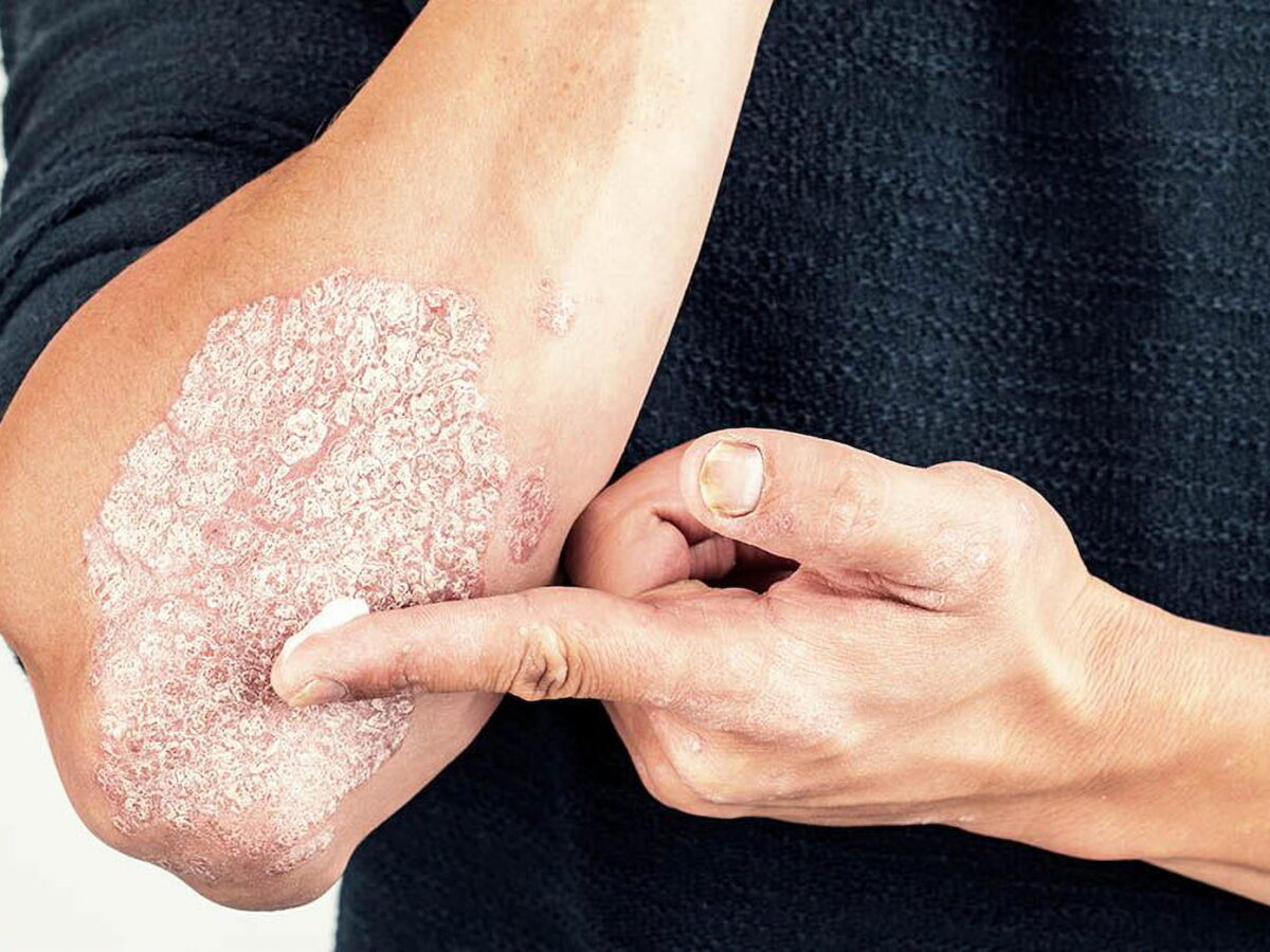 Zoryve: New Effective Cream for Psoriasis