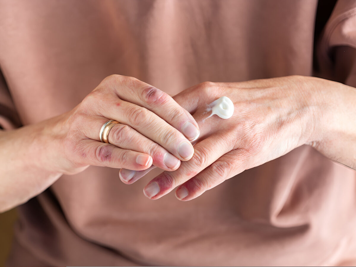 Apogee Therapeutics: Treating Eczema With Two Injections per Year