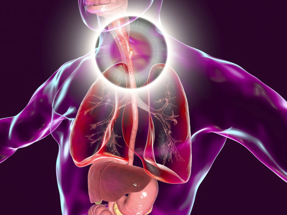 Tevimbra: Immuno-Oncologic Treatment for Esophageal Cancer