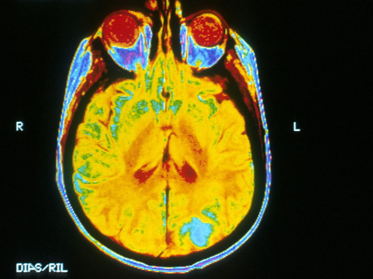 Ojemda: Novel Treatment for Low-grade Glioma