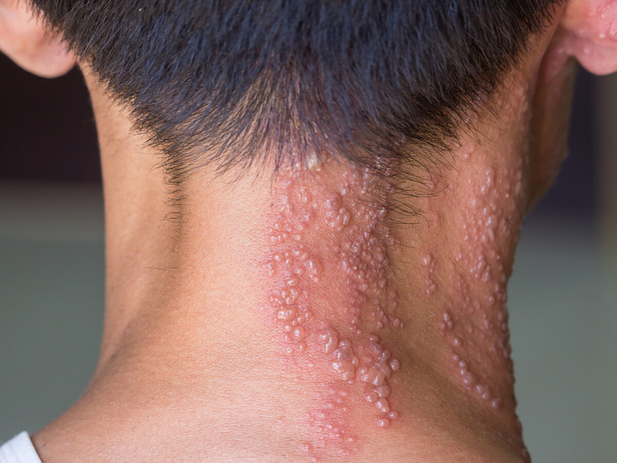 Shingrix: Excellent Vaccine Against Shingles