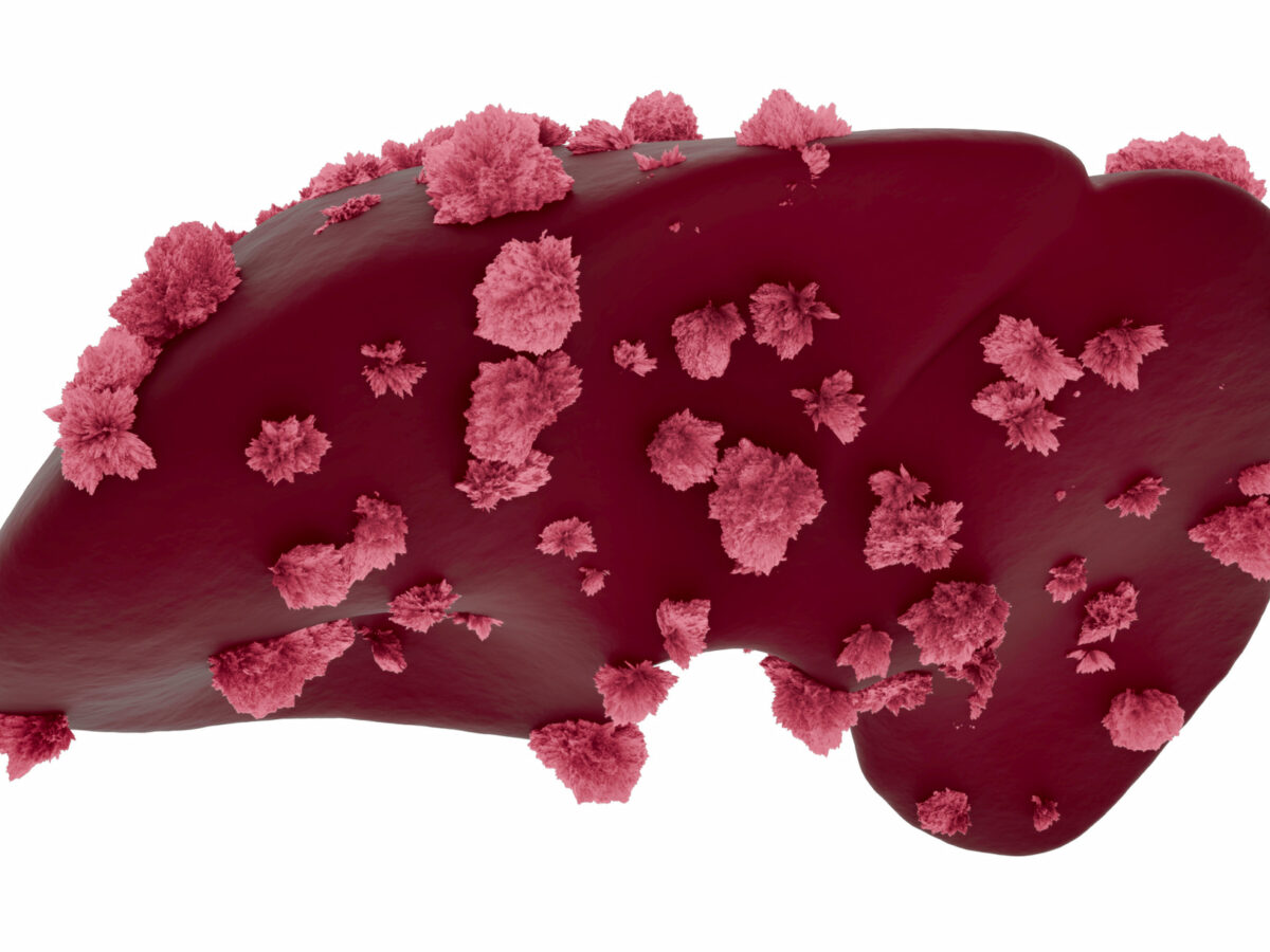 Liver Cancer: Personalized Vaccine for Complete Remission